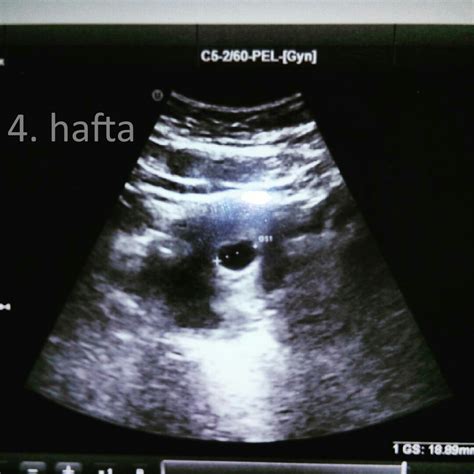 4 haftalık gebelik ultrasonda görülürmü